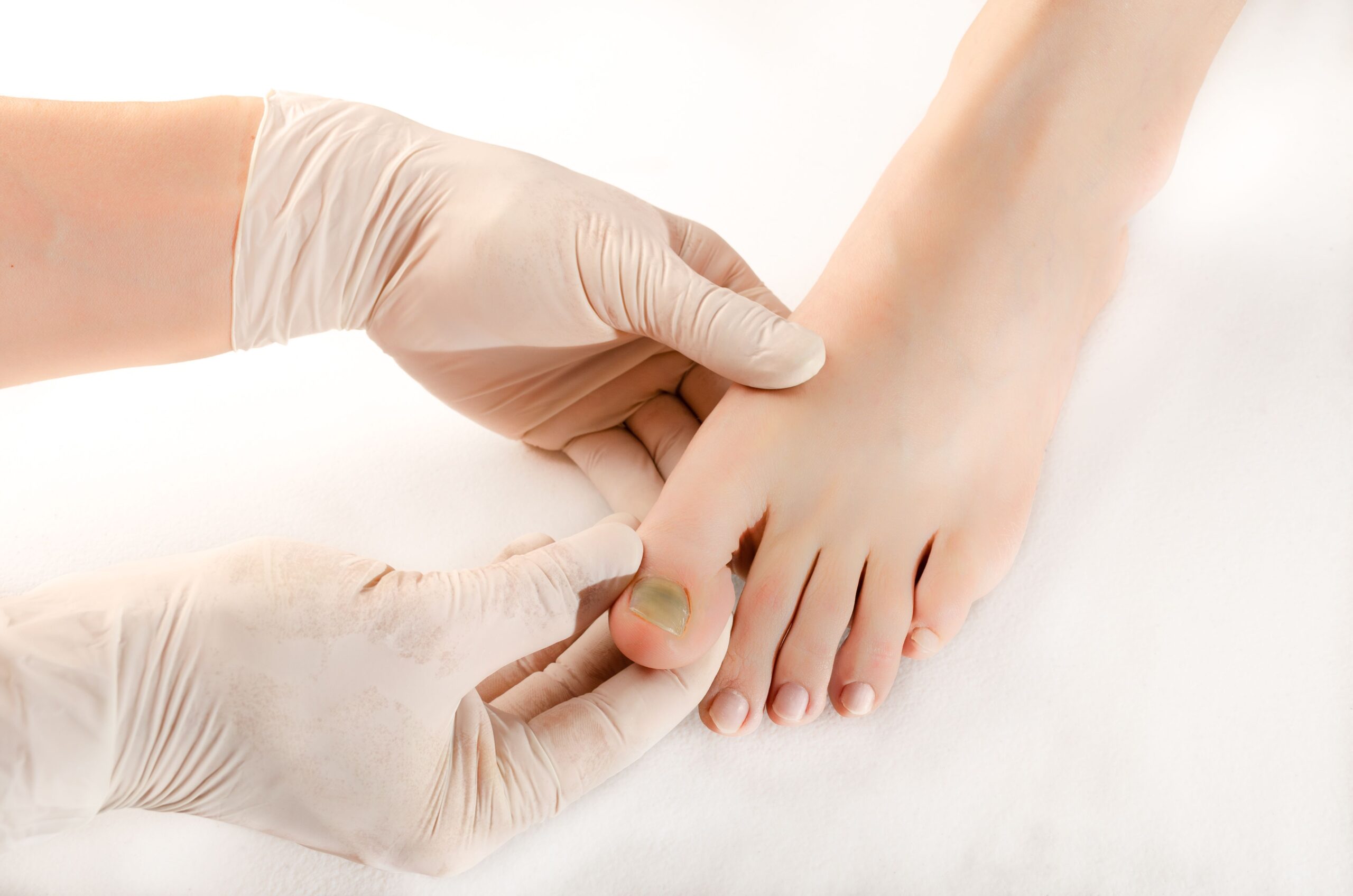 Subungual hematoma in the nail