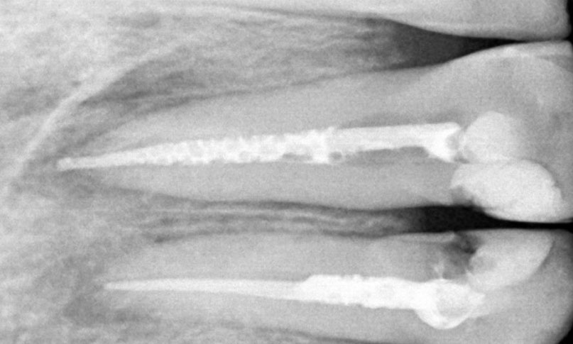 Endodoncia