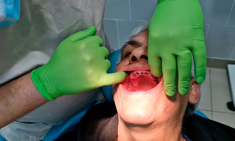 Maxilofacial