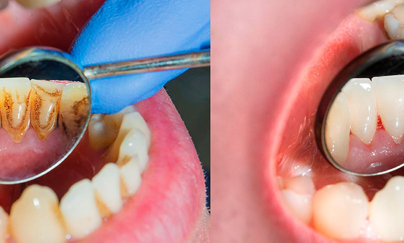 Periodoncia