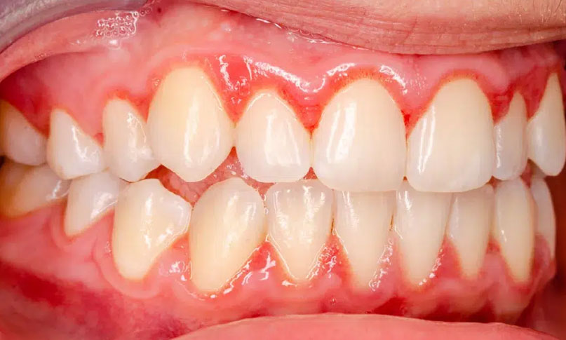 Periodoncia